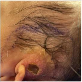 Case Report: Profound newborn leukopenia related to a novel RAC2 variant